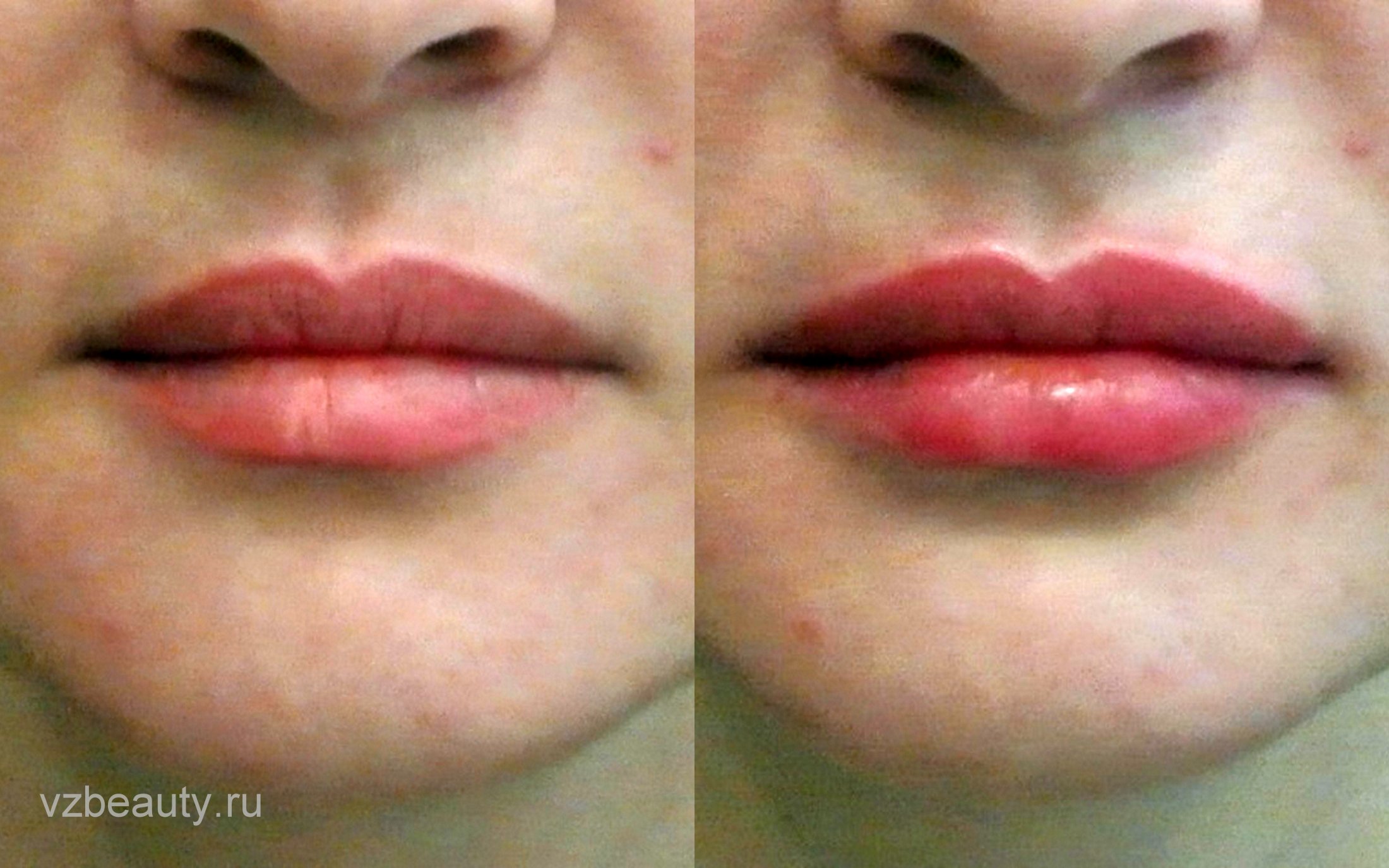 Увлажнение губ до и после. Гиалуронка в губы для увлажнения. Увлажненные губы до и после.
