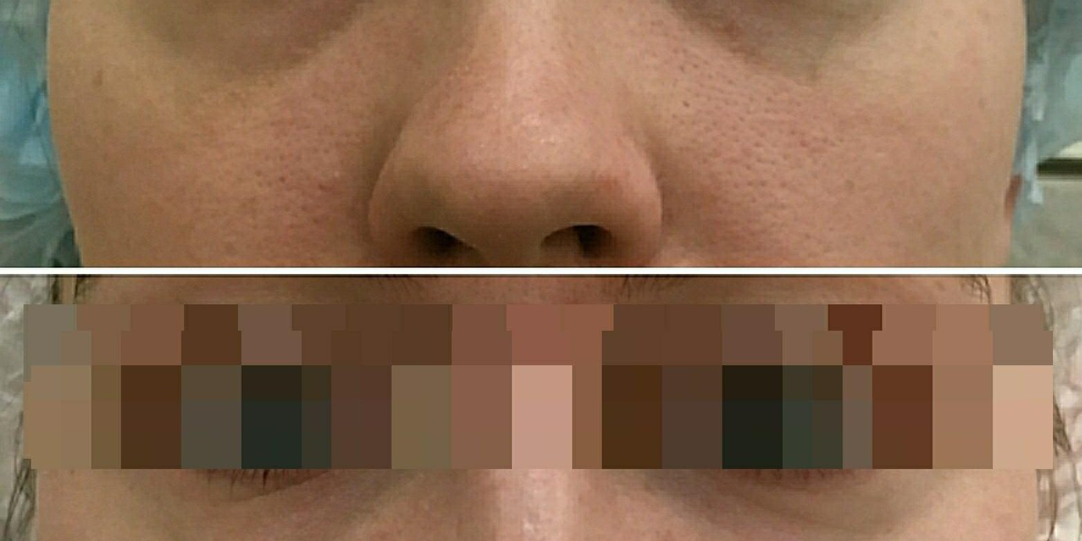 восполнения объема в средней трети лица восполнения объема в средней трети лица