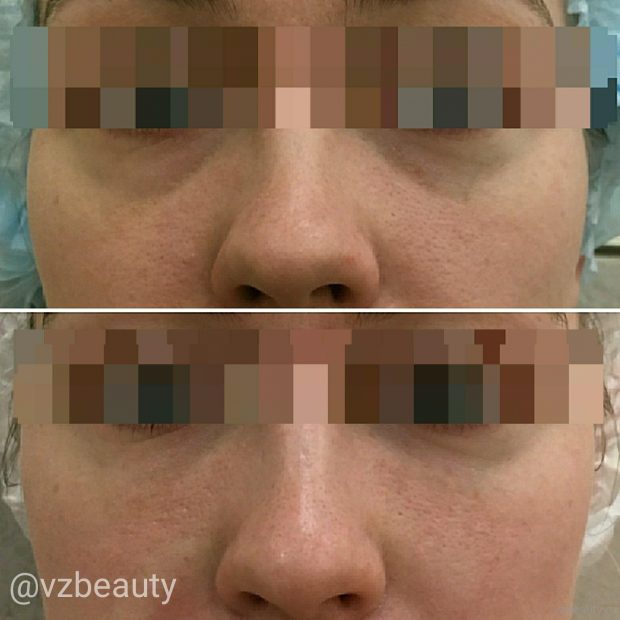 восполнения объема в средней трети лица восполнения объема в средней трети лица