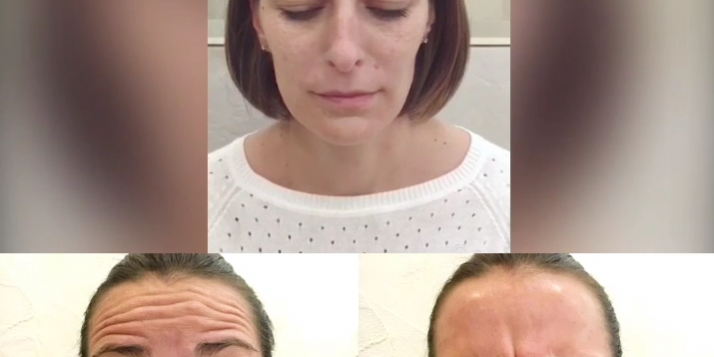 ботокс, инъекции ботокс