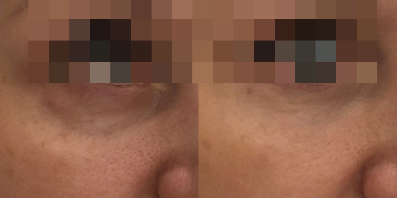 заполнить носослезку