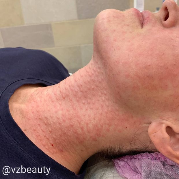 биоревитализация шеи лица