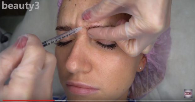 ботокс видео