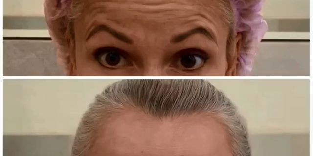 ботокс в лоб 2021