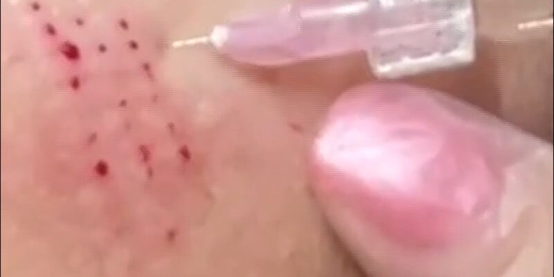 Бланширование сайт