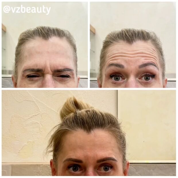 Результат инъекций фото ТГ