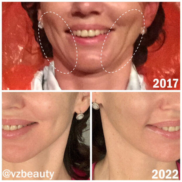 результат мезонитей