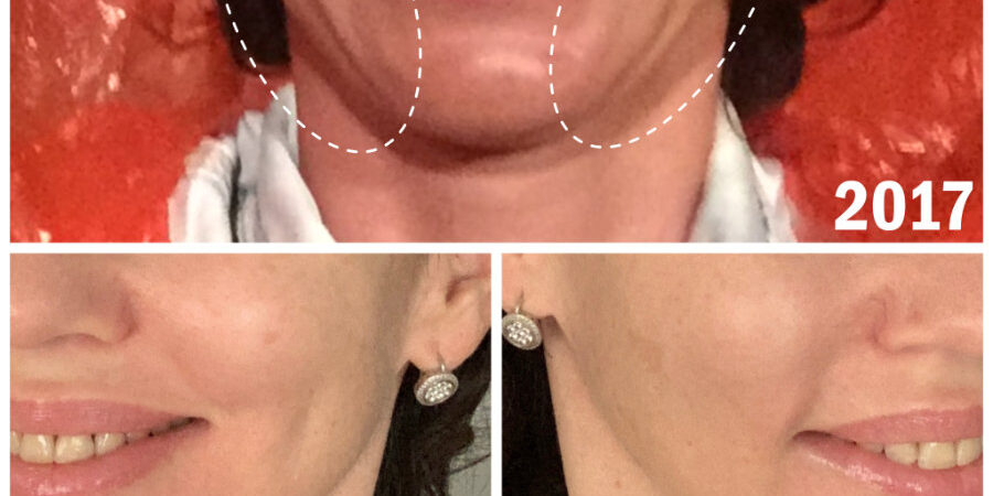 результат мезонитей