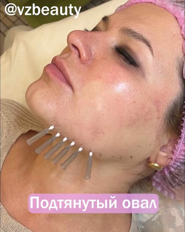 нити мезо главное фото записи