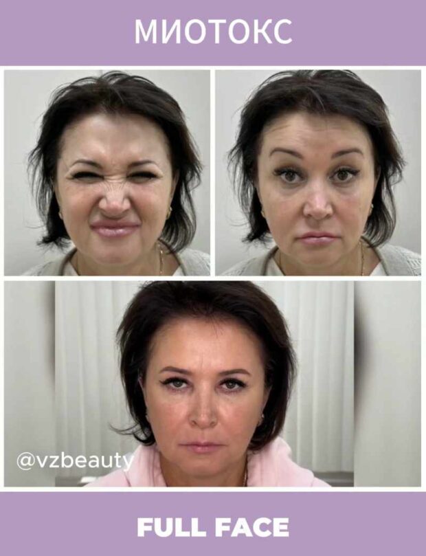 ботокс фулл фейс