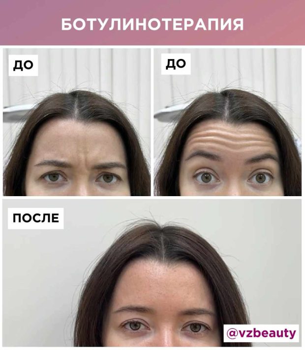 для сайтпа ботокс